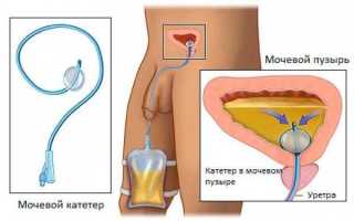 Катетеризация, виды катетеров и урологических средств
