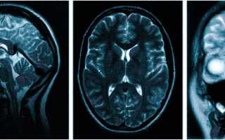 Если болит голова какое мрт надо делать