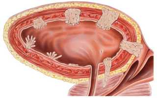 Какие симптомы рака мочевого пузыря у женщин? Рак мочевого пузыря у женщин: признаки, диагностика