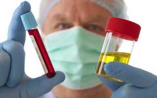 Лабораторные анализы в урологии