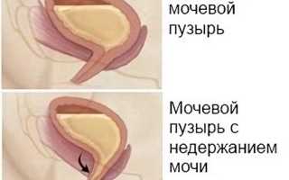 Частое мочеиспускание после тур простаты