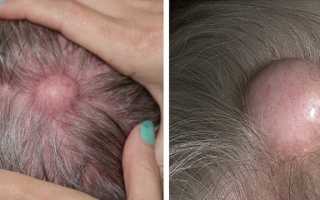 Шишка на голове болит и чешется что это может быть