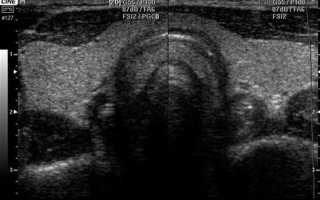 Лазерное лечение урологии на во