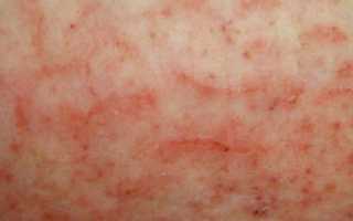 Помогает ли пимафукорт при молочнице?