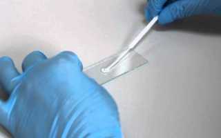 Забор урологических мазков у мужчин