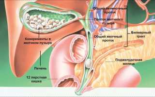 Может ли болеть голова из за камней в желчном