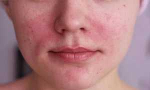 Красное лицо и болит голова у женщины причины