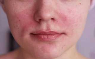 Горят глаза и лицо болит голова