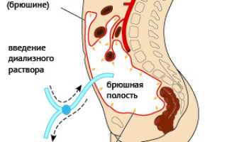 Применение БАД Компании NSP при хронической почечной недостаточности. Санкт-Петербург.