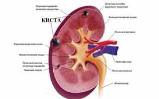 Киста правой и левой почки – причины, симптомы и лечение кисты почки, удаление (операция)
