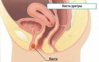 Парауретральная киста — симптомы, удаление и операция