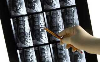 Сильно болит спина мрт