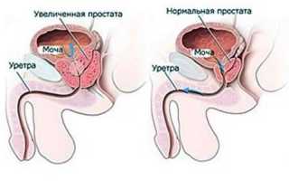 Современные методы лечения аденомы простаты — Простатит