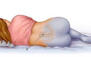 Как долго будет болеть спина после эпидуралки