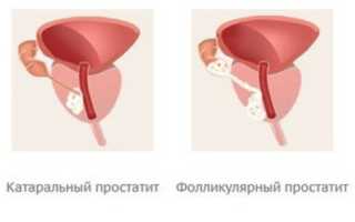 Препараты при хроническом простатите у мужчин