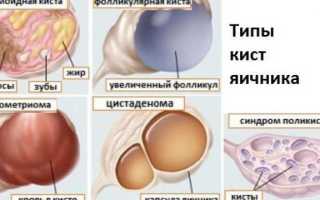 Киста на яичнике у женщин: лечение или операция?