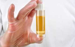 Что показывает анализ мочи и общий анализ мочи