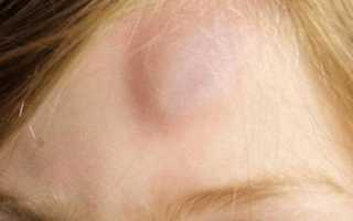 Появилась шишечка на голове и болит голова