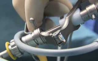 Послеоперационный период тур мочевого пузыря