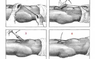 Как проходит катетеризация мочевого пузыря у мужчин – алгоритм проведения и видео, техника выполнения, как вставлять катетер, последствия и осложнения