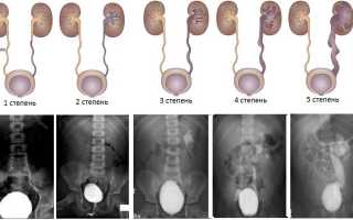 Мочеточниковый Рефлюкс у Детей