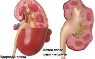 Можно ли вылечить хронический пиелонефрит навсегда