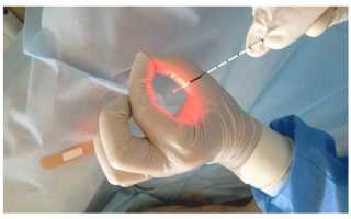 Аппараты для терапии в урологии