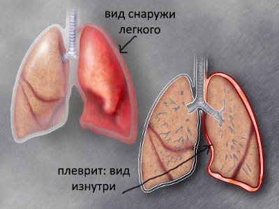 При глубоком вдохе болит спина и ребра