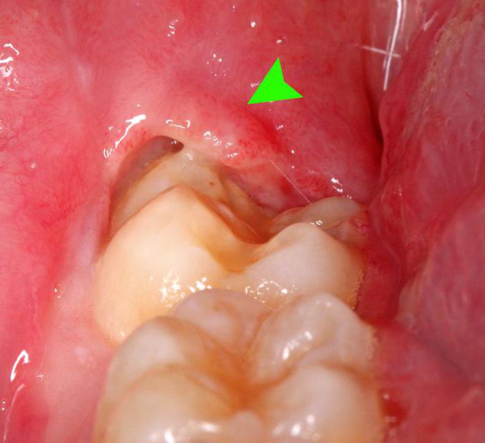 растет зуб мудрости болит голова