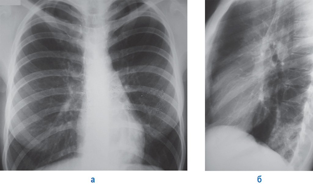 Почему болит левая лопатка на спине при вдохе