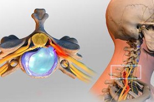 От грыжи позвоночника может болеть голова