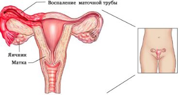 Перед и после месячных болит спина