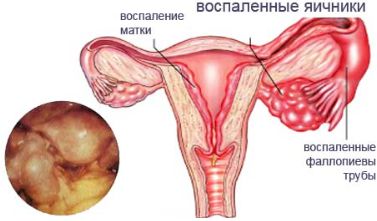 Перед и после месячных болит спина