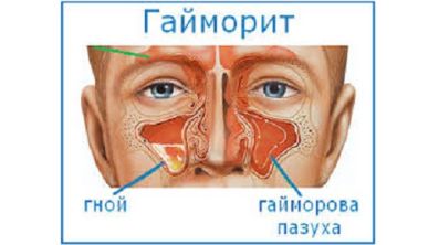 вечером поднимается температура и болит спина