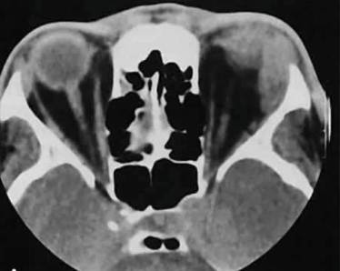 При простуде болит шея сзади и голова