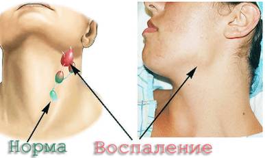 вечером поднимается температура и болит спина