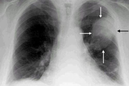 Рак легкого на рентгене