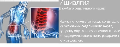 Почему возникают неприятные ощущения в пояснице