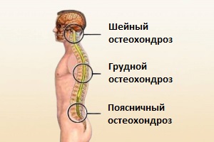 Остеохондроз Остеохондроз