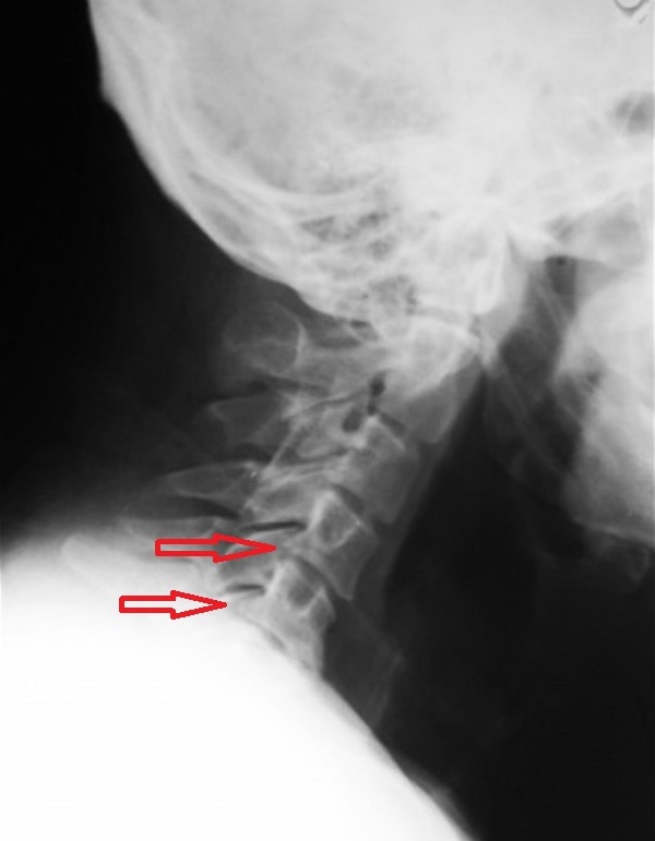 Болит шея при наклоне головы вправо и влево