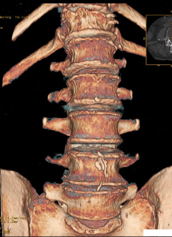 Болит спина справа от крестца