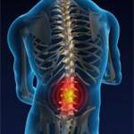 грыжа поясничного отдела