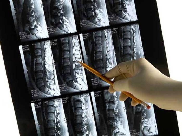 МРТ поясницы