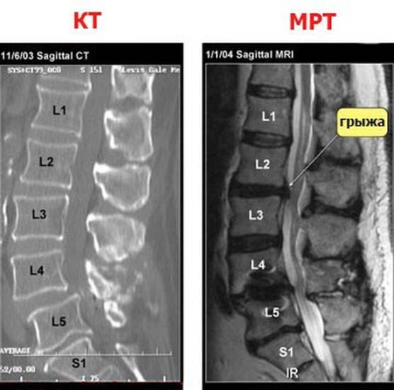 МРТ и КТ позвоночника