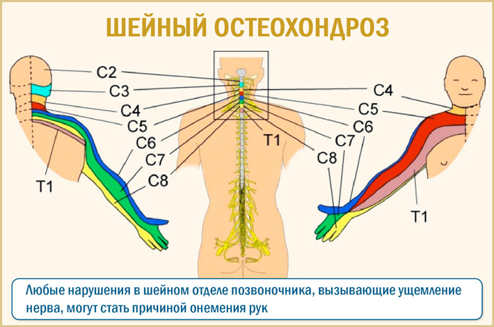 Остеохондроз Шейный остеохондроз