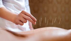 Акупунктура