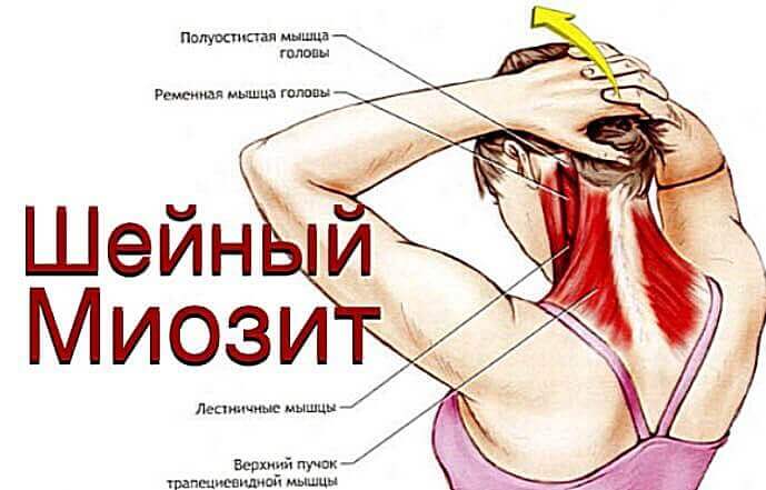 Шейный миозит