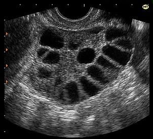 Перед и после месячных болит спина