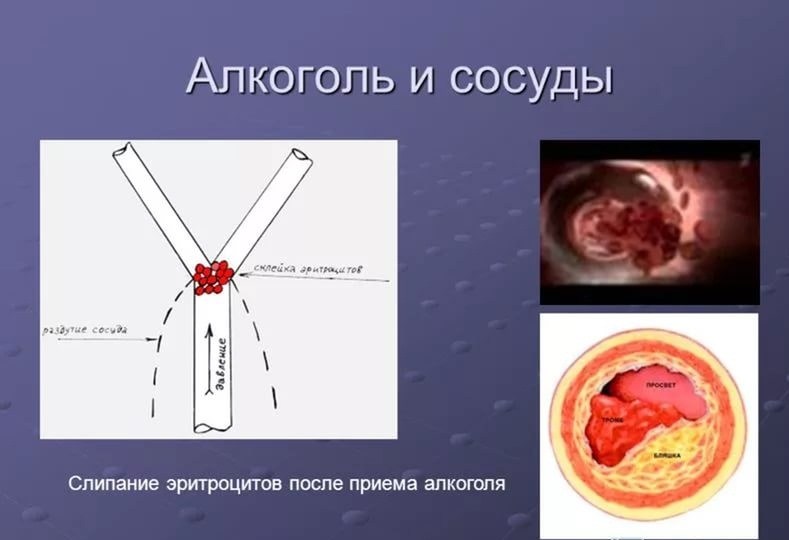 Воздействие алкоголя на сосуды Воздействие алкоголя на сосуды