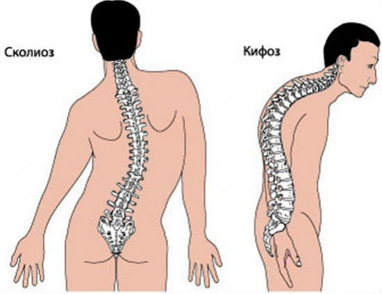 Сколиоз и кифоз